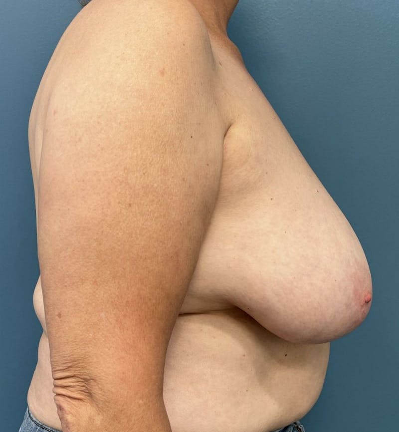 Breast Reduction Before & After Gallery - Patient 105878 - Image 3