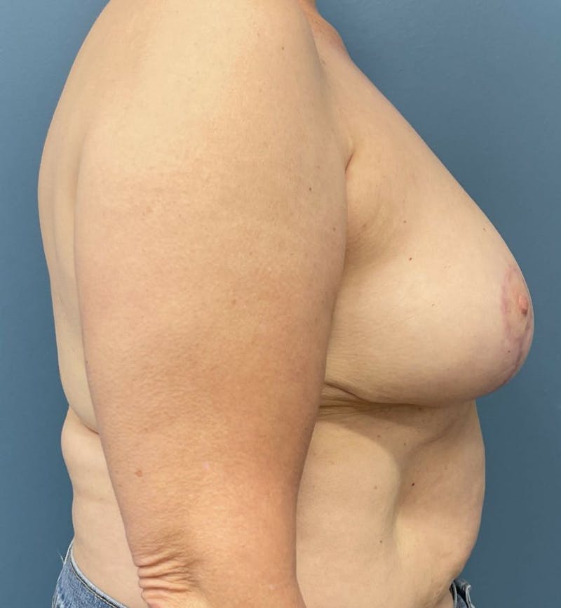 Breast Reduction Before & After Gallery - Patient 105878 - Image 4