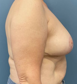 Breast Reduction Before & After Gallery - Patient 105878 - Image 4