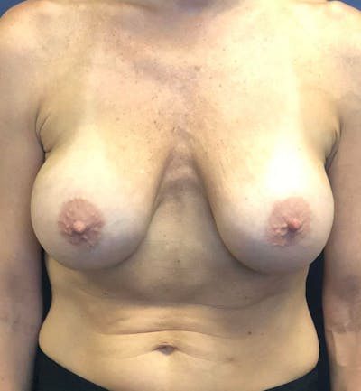 Breast Revision  Before & After Gallery - Patient 239443 - Image 1