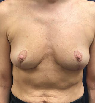 Breast Revision  Before & After Gallery - Patient 239443 - Image 2