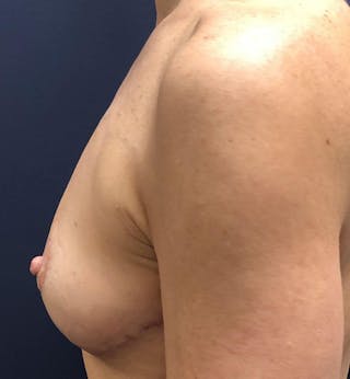 Breast Revision  Before & After Gallery - Patient 239443 - Image 4
