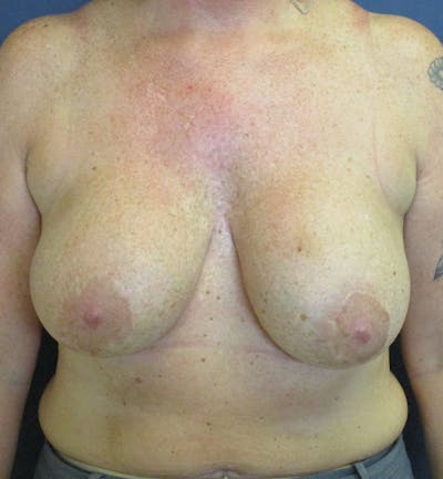 Breast Revision  Before & After Gallery - Patient 433716 - Image 1