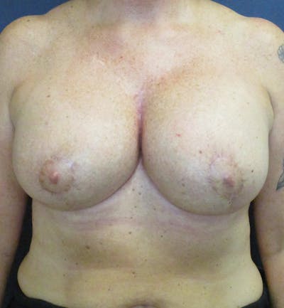 Breast Revision  Before & After Gallery - Patient 433716 - Image 2