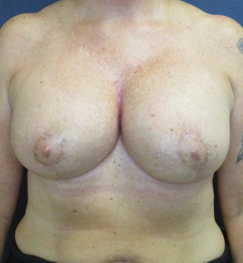 Breast Revision  Before & After Gallery - Patient 433716 - Image 2