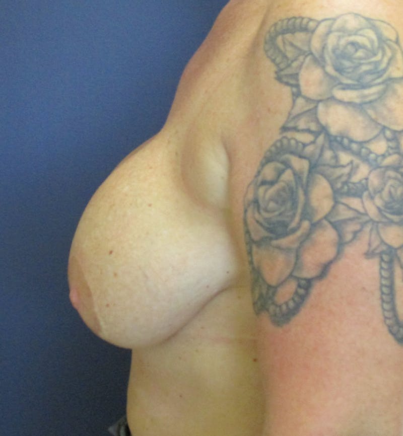 Breast Revision  Before & After Gallery - Patient 433716 - Image 3