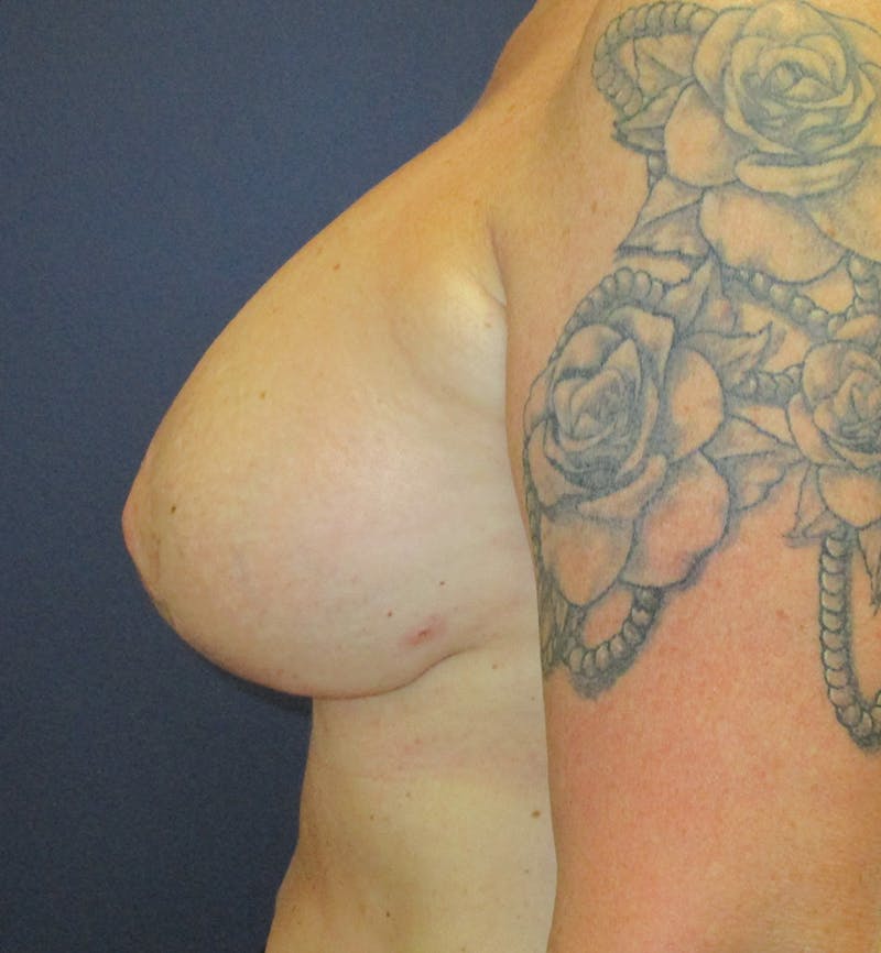 Breast Revision  Before & After Gallery - Patient 433716 - Image 4