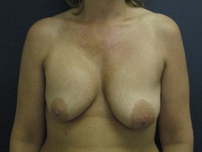 Breast Revision  Before & After Gallery - Patient 423518 - Image 1