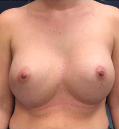 Breast Revision  Before & After Gallery - Patient 309043 - Image 1