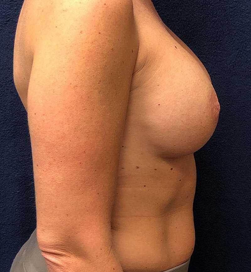 Breast Revision  Before & After Gallery - Patient 232812 - Image 3