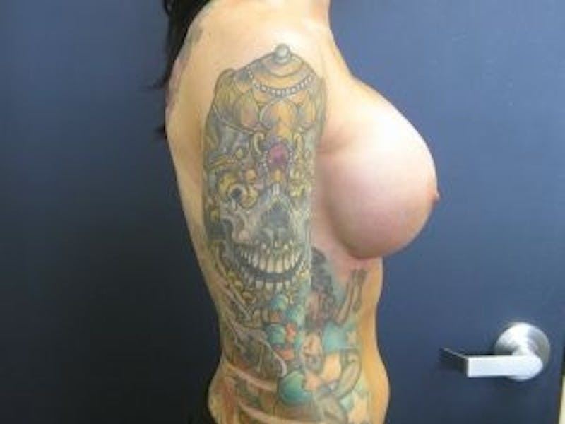 Breast Revision  Before & After Gallery - Patient 226860 - Image 4