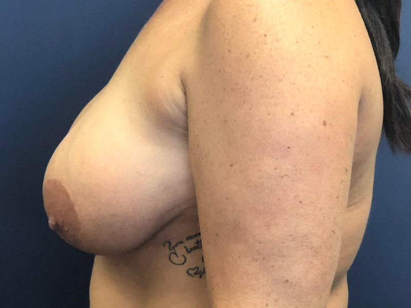 Breast Revision  Before & After Gallery - Patient 135504 - Image 3