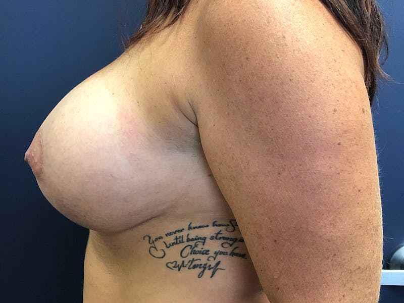 Breast Revision  Before & After Gallery - Patient 135504 - Image 4