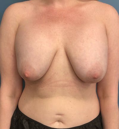 Breast Revision  Before & After Gallery - Patient 257528 - Image 1