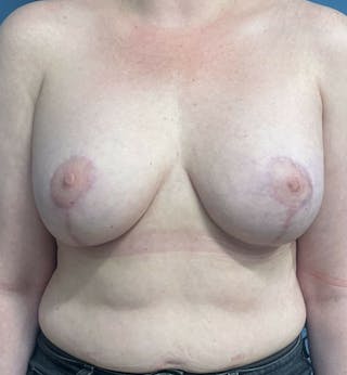 Breast Revision Before & After Gallery - Patient 257528 - Image 2