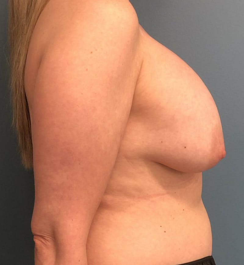 Breast Revision  Before & After Gallery - Patient 257528 - Image 3