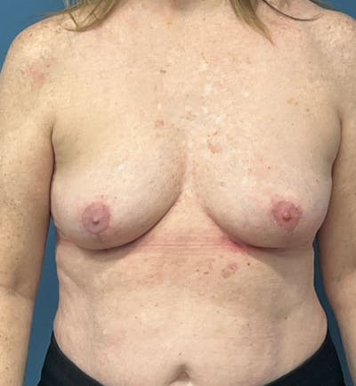 Breast Revision  Before & After Gallery - Patient 355358 - Image 2