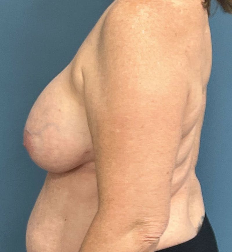 Breast Revision  Before & After Gallery - Patient 355358 - Image 3