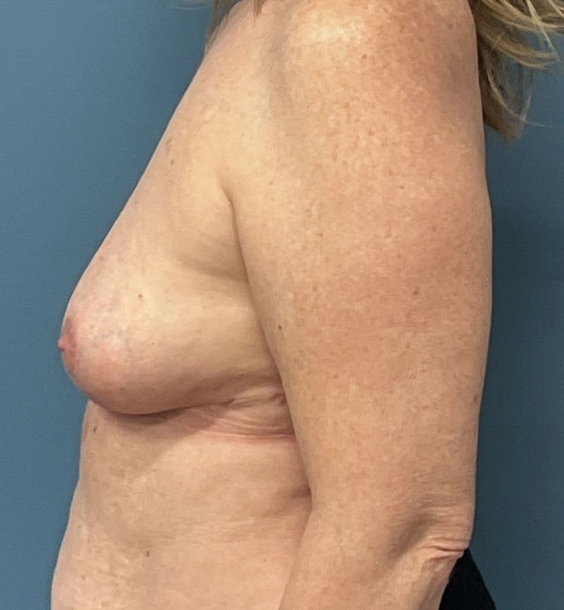 Breast Revision  Before & After Gallery - Patient 355358 - Image 4