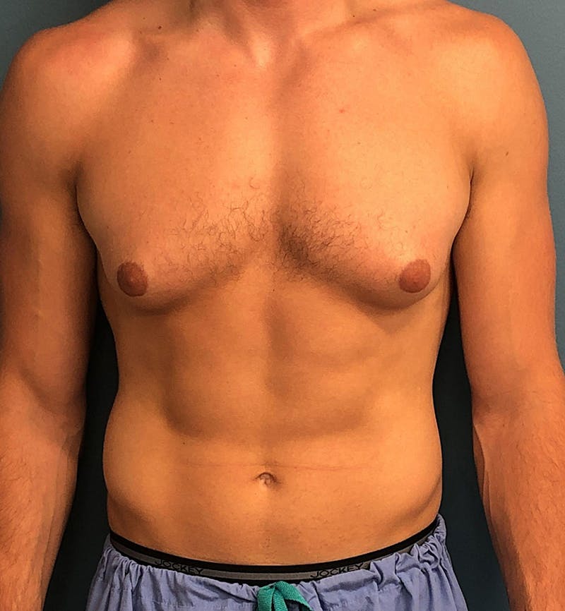 Male Breast Reduction Before & After Gallery - Patient 635265 - Image 1