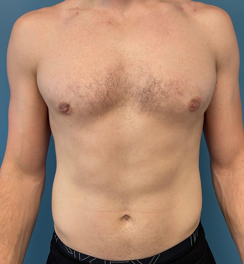 Male Breast Reduction Before & After Gallery - Patient 635265 - Image 2