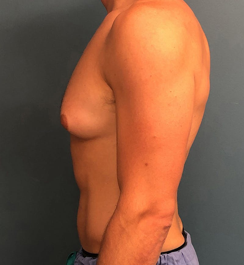 Male Breast Reduction Before & After Gallery - Patient 635265 - Image 3