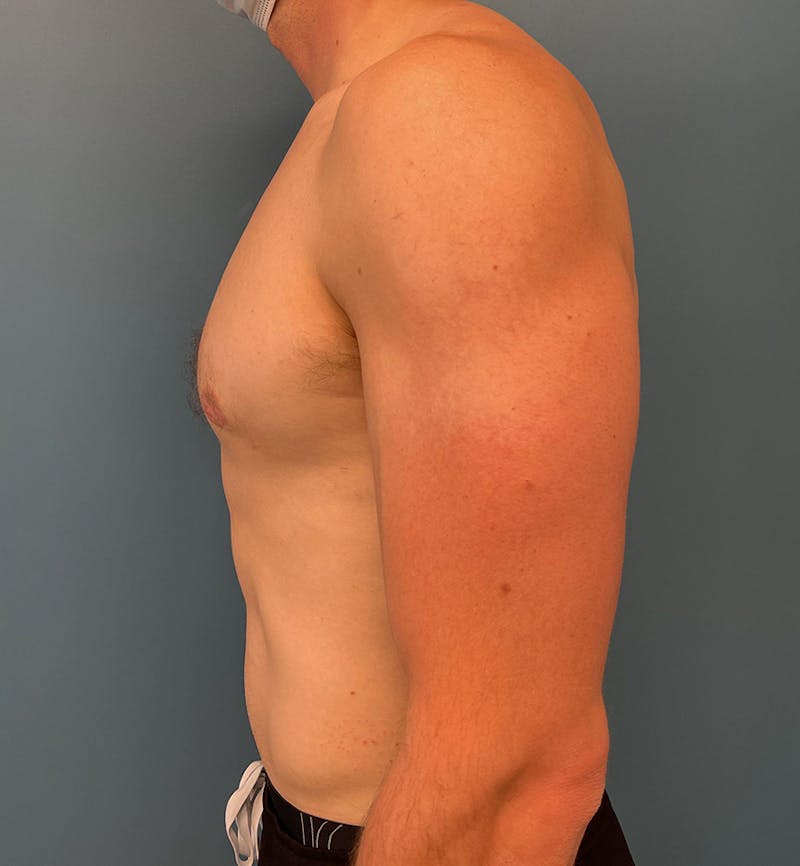 Male Breast Reduction Before & After Gallery - Patient 635265 - Image 4