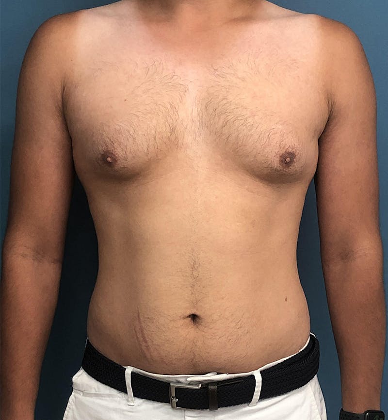 Male Breast Reduction Before & After Gallery - Patient 405648 - Image 1