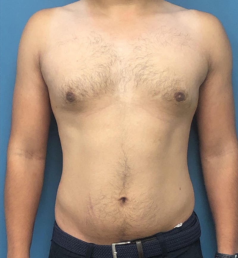 Male Breast Reduction Before & After Gallery - Patient 405648 - Image 2