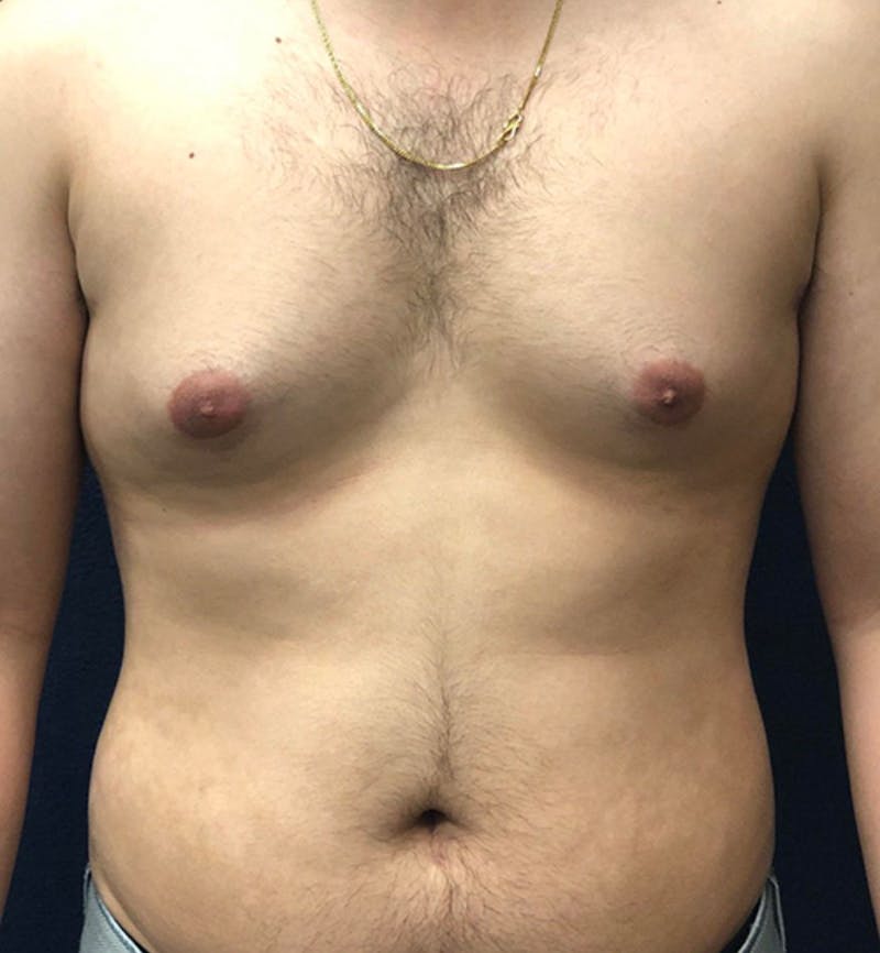 Male Breast Reduction Before & After Gallery - Patient 195204 - Image 1