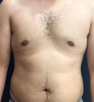 Male Breast Reduction Before & After Gallery - Patient 195204 - Image 2