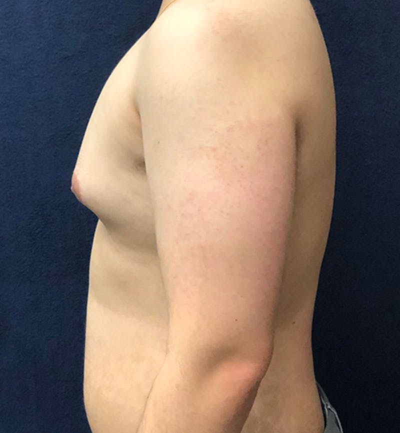 Male Breast Reduction Before & After Gallery - Patient 195204 - Image 3