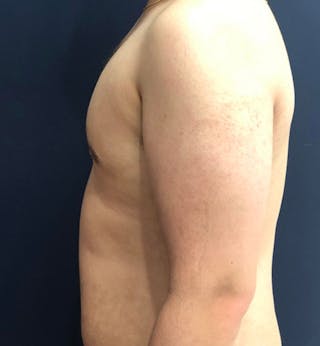 Male Breast Reduction Before & After Gallery - Patient 195204 - Image 4
