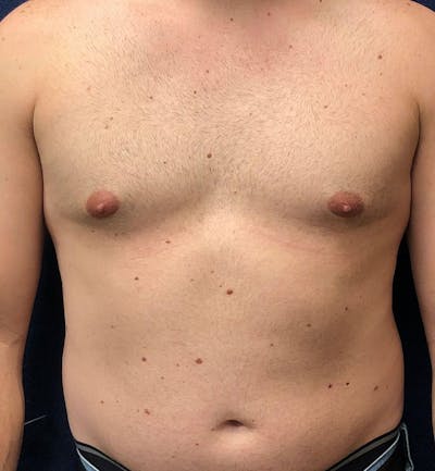 Male Breast Reduction Before & After Gallery - Patient 794875 - Image 1