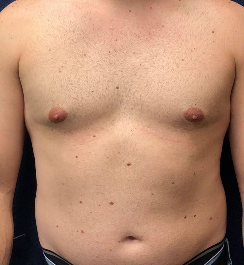 Male Breast Reduction Before & After Gallery - Patient 794875 - Image 1
