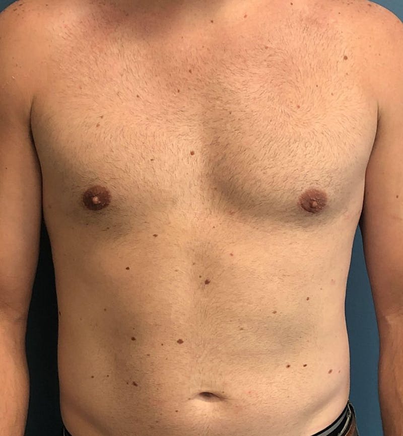 Male Breast Reduction Before & After Gallery - Patient 794875 - Image 2