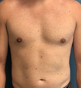 Male Breast Reduction Before & After Gallery - Patient 794875 - Image 2