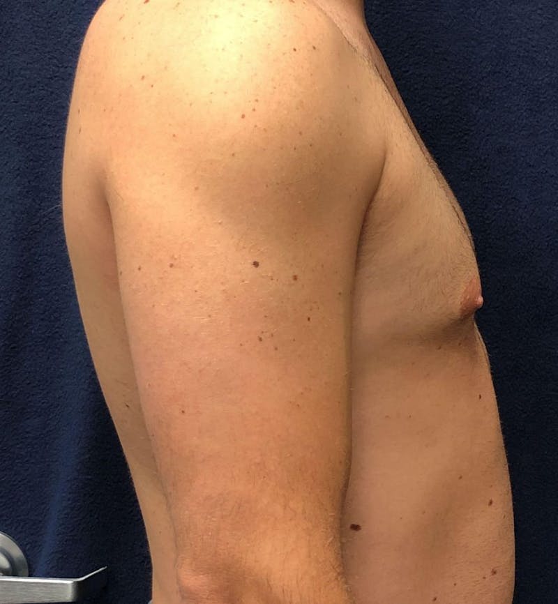 Male Breast Reduction Before & After Gallery - Patient 794875 - Image 3