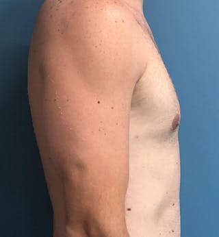 Male Breast Reduction Before & After Gallery - Patient 794875 - Image 4