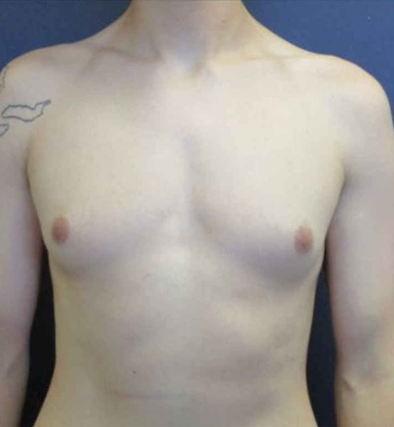 Male Breast Reduction Before & After Gallery - Patient 362099 - Image 1