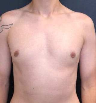 Male Breast Reduction Before & After Gallery - Patient 362099 - Image 2