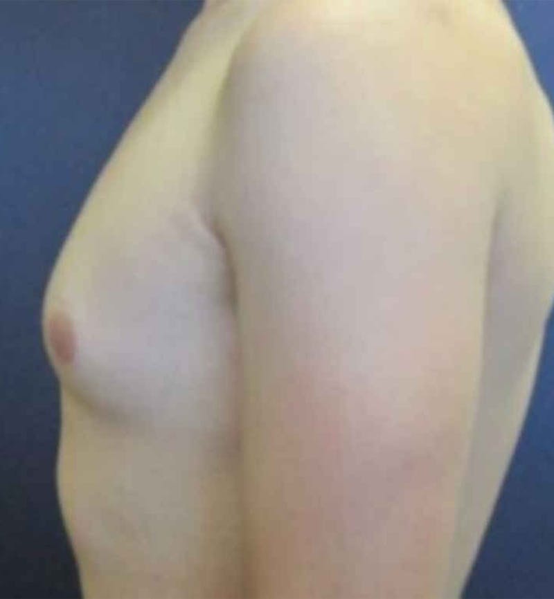 Male Breast Reduction Before & After Gallery - Patient 362099 - Image 3