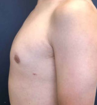 Male Breast Reduction Before & After Gallery - Patient 362099 - Image 4