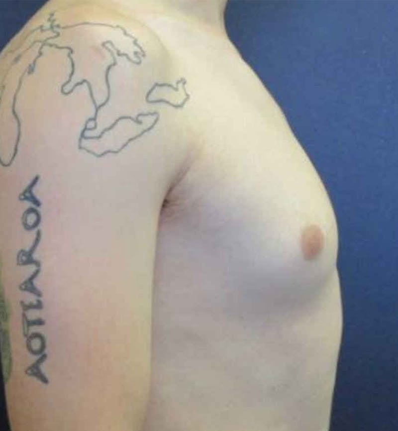 Male Breast Reduction Before & After Gallery - Patient 362099 - Image 5
