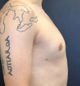 Male Breast Reduction Before & After Gallery - Patient 362099 - Image 6