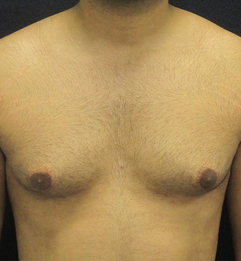 Male Breast Reduction Before & After Gallery - Patient 296051 - Image 1