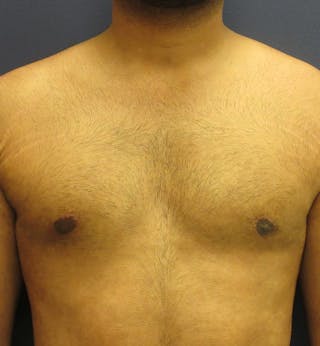 Male Breast Reduction Before & After Gallery - Patient 296051 - Image 2