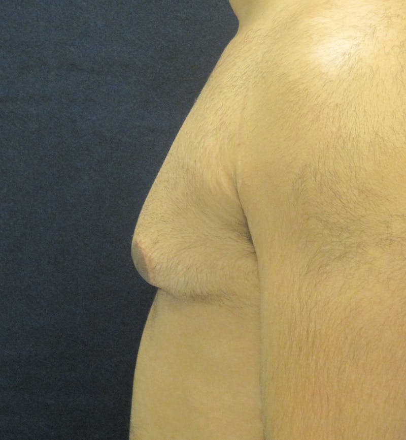 Male Breast Reduction Before & After Gallery - Patient 296051 - Image 3