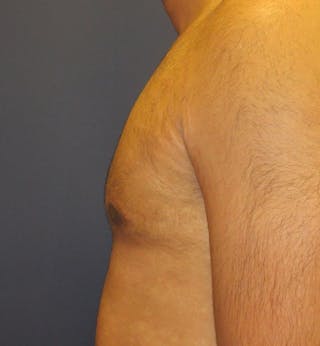 Male Breast Reduction Before & After Gallery - Patient 296051 - Image 4