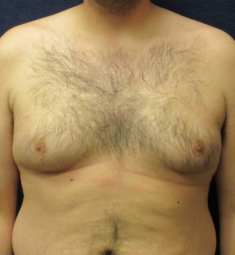 Male Breast Reduction Before & After Gallery - Patient 175226 - Image 1